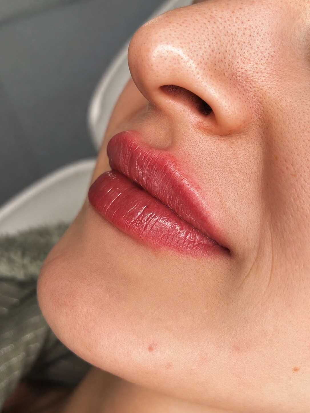 Ästhetik-Behandlung: Lippen nach Unterspritzung mit Hyaluronsäure